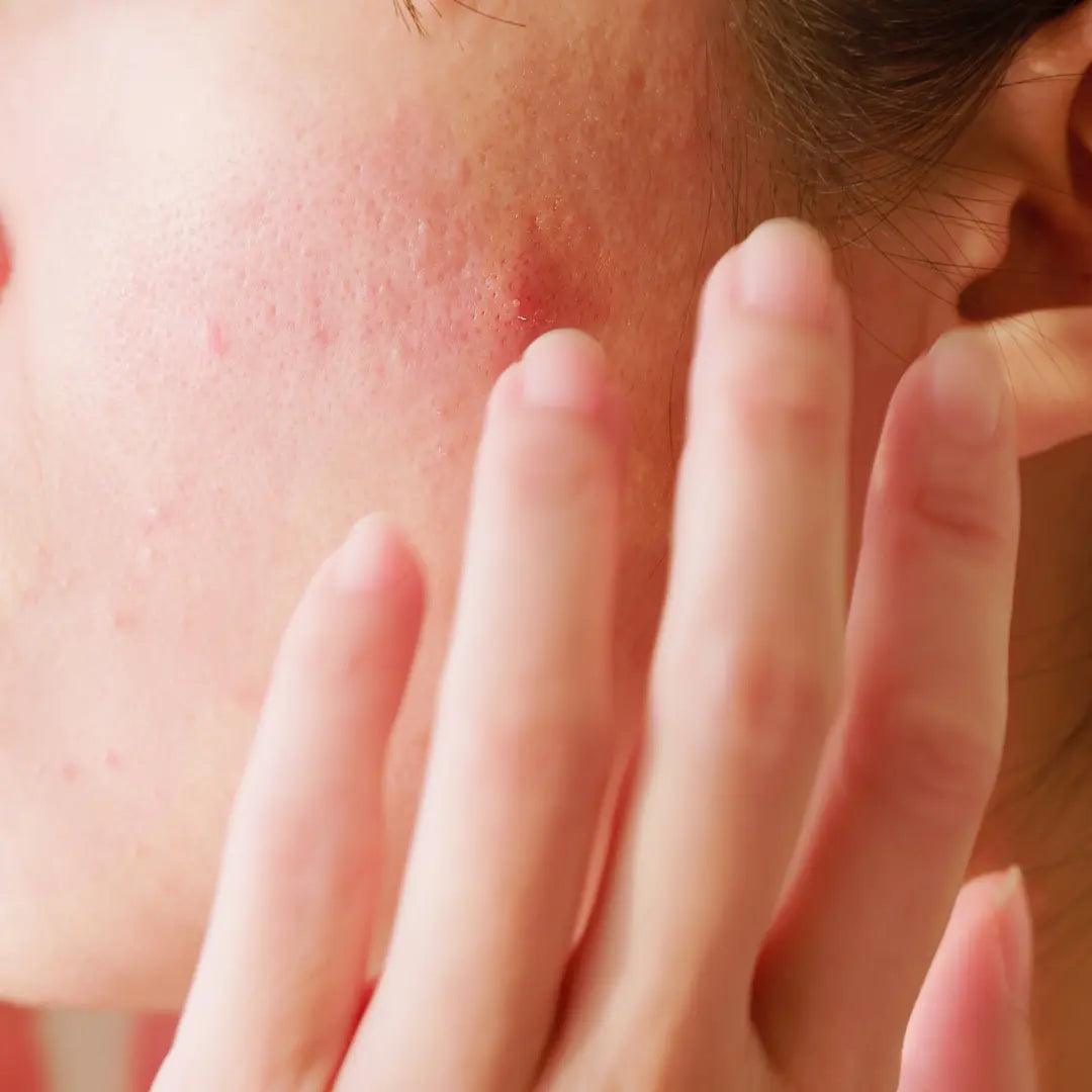 The Ultimate Guide to Keeping Your Skin Hydrated from Dryness